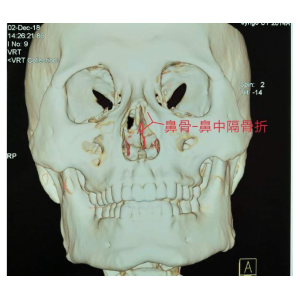 貴陽銘仁耳鼻喉醫(yī)院提醒您：鼻子很脆弱，要好好保護(hù)