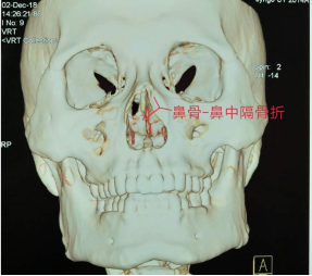 十歲小孩被書本砸破鼻子，(圖1)