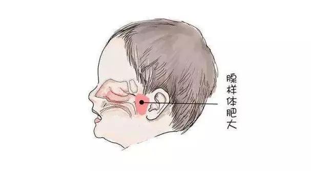 銘仁耳鼻喉專家分享：兒童腺樣體肥大怎么治療比較好？(圖1)