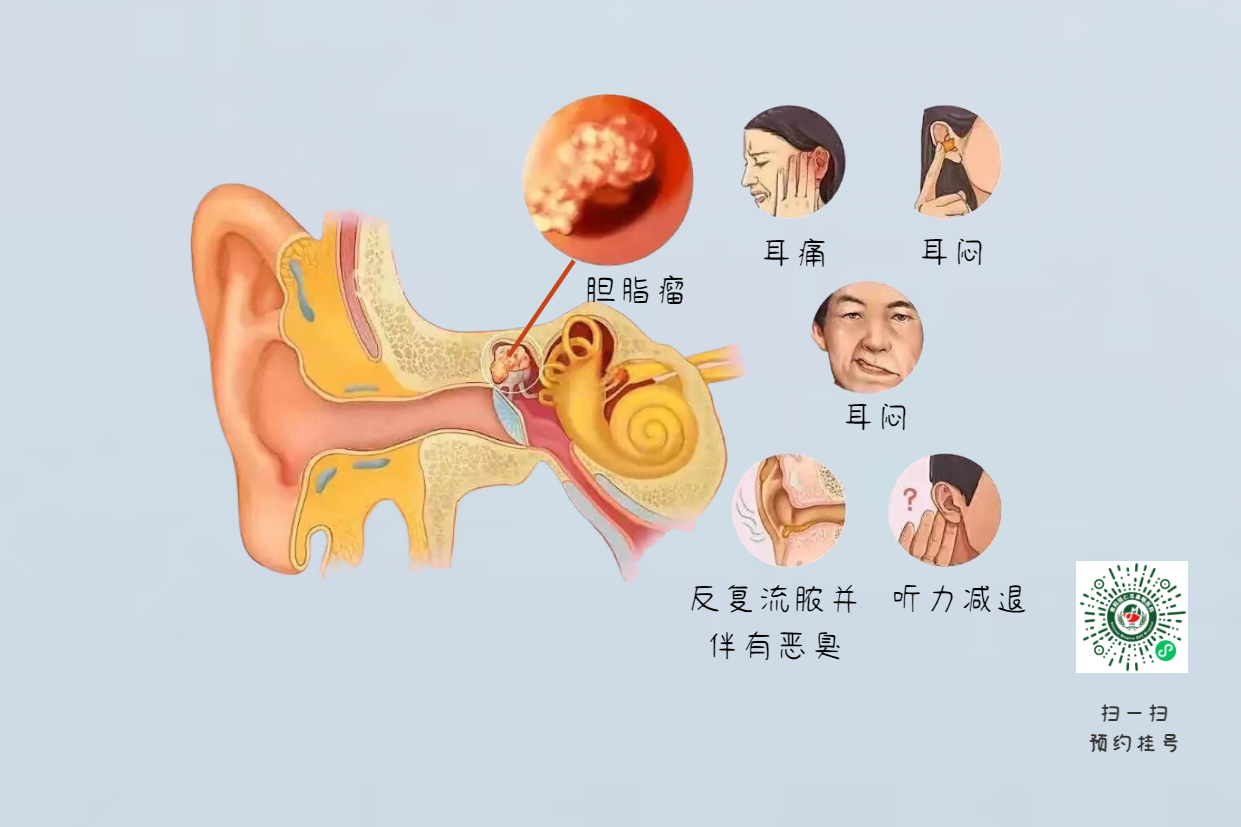 手術(shù)沒(méi)做干凈，術(shù)后3年顱內(nèi)竟發(fā)現(xiàn)巨大膽脂瘤！(圖6)