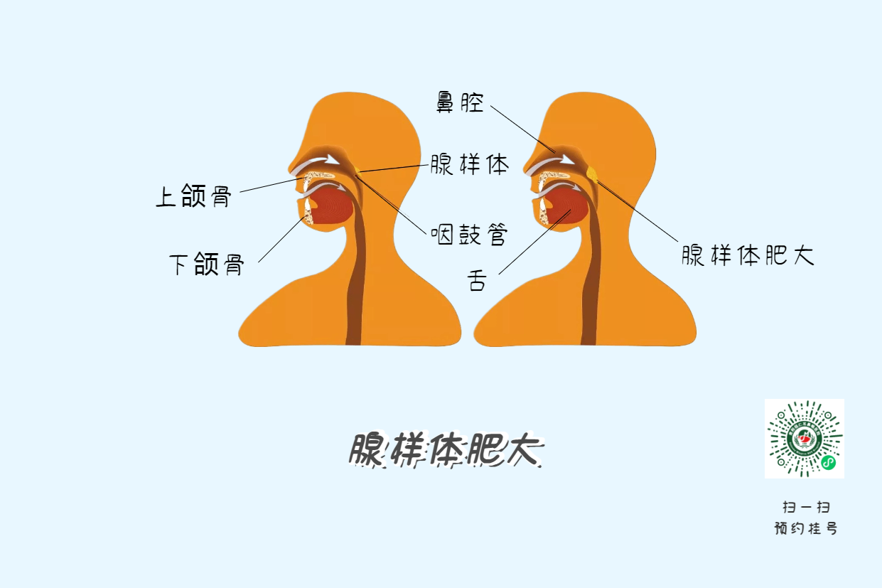 暑假來(lái)了，孩子腺樣體肥大到底切不切？(圖4)