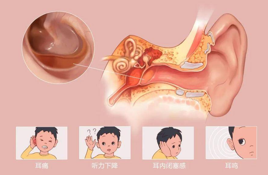  夏季游泳，謹防中耳炎“找麻煩”！(圖3)