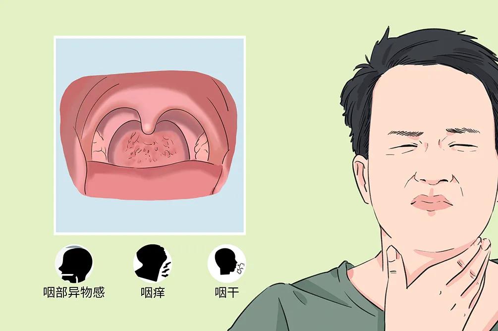 慢性咽炎的困擾：咽干、咽痛、咽部異物感(圖2)