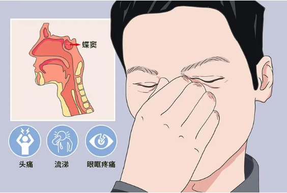 頭疼、眼痛雖小，卻可能是蝶竇炎發(fā)出的警告信號(hào)！(圖1)