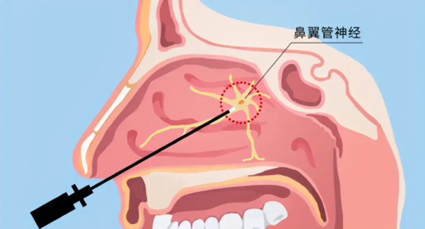 頭疼、眼痛雖小，卻可能是蝶竇炎發(fā)出的警告信號(hào)！(圖2)