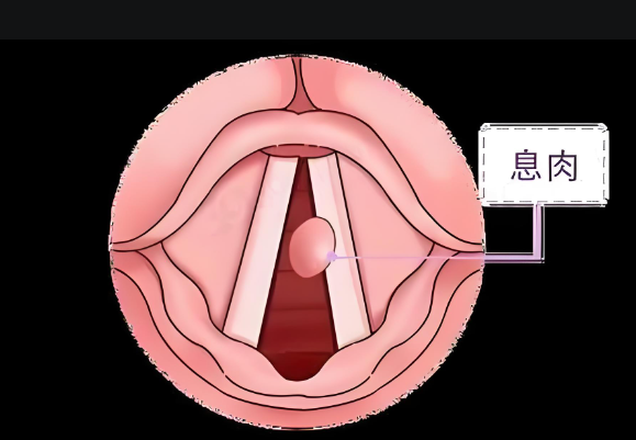 聲音嘶啞、嗓子難受，聲帶息肉不可小覷(圖1)