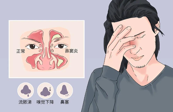 為什么感冒容易導(dǎo)致鼻竇炎，鼻竇炎該如何預(yù)防？(圖1)