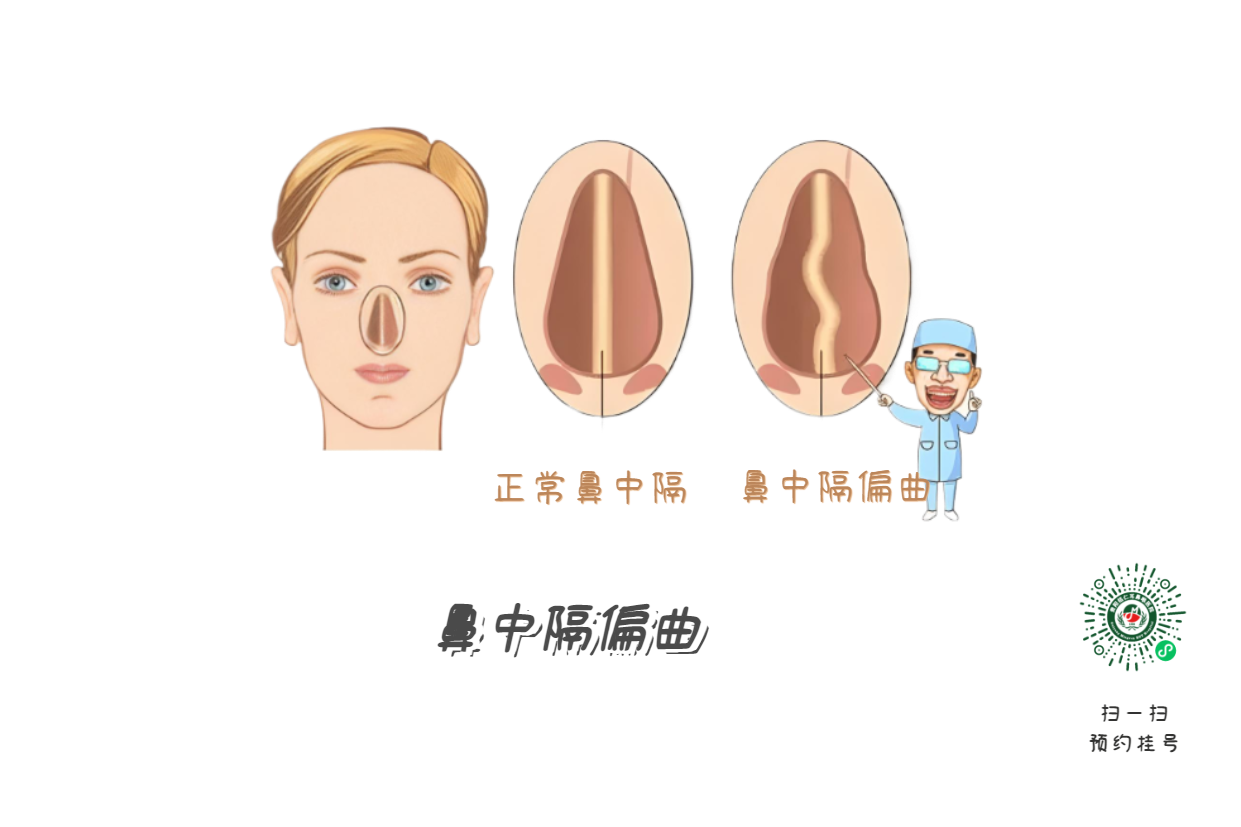 鼻塞、流涕、打噴嚏，是鼻炎引起的？注意可能是鼻中隔偏曲！(圖1)