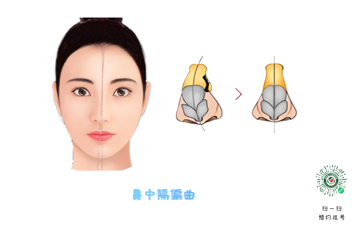 別把鼻塞當(dāng)小事 它可能是鼻腔內(nèi)的“隱形戰(zhàn)爭(zhēng)”(圖1)
