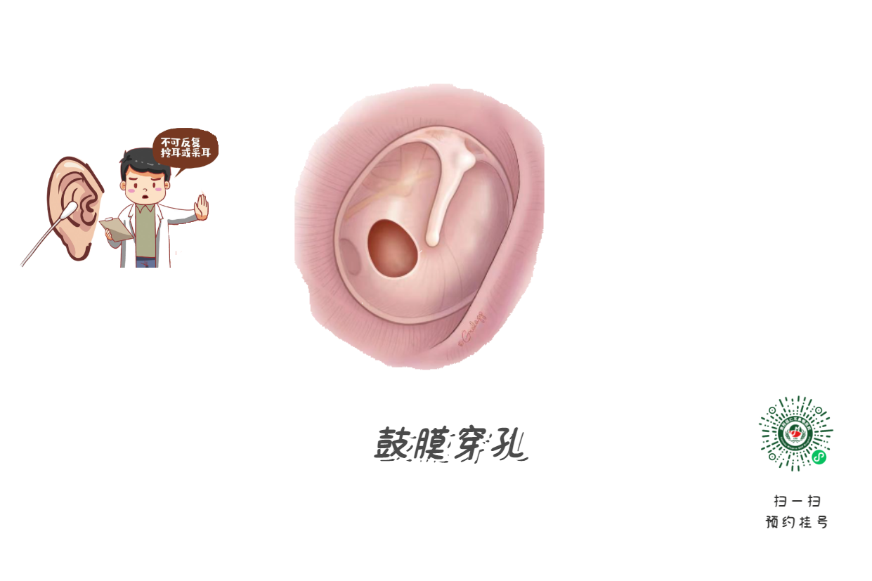 掏耳勺上的血絲：耳道劃傷還是腫瘤預(yù)警？(圖2)