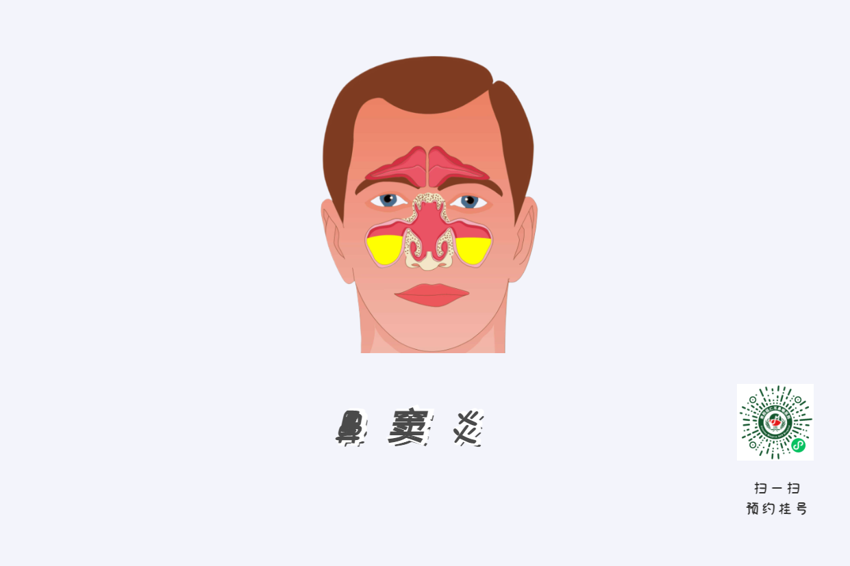 鼻竇炎頭痛有特點(diǎn)！這個位置痛要當(dāng)心(圖1)