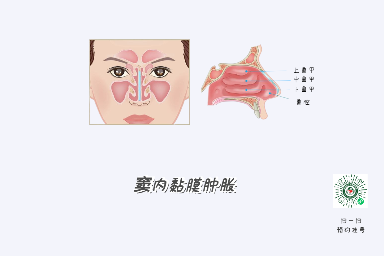 鼻竇炎頭痛有特點(diǎn)！這個位置痛要當(dāng)心(圖4)