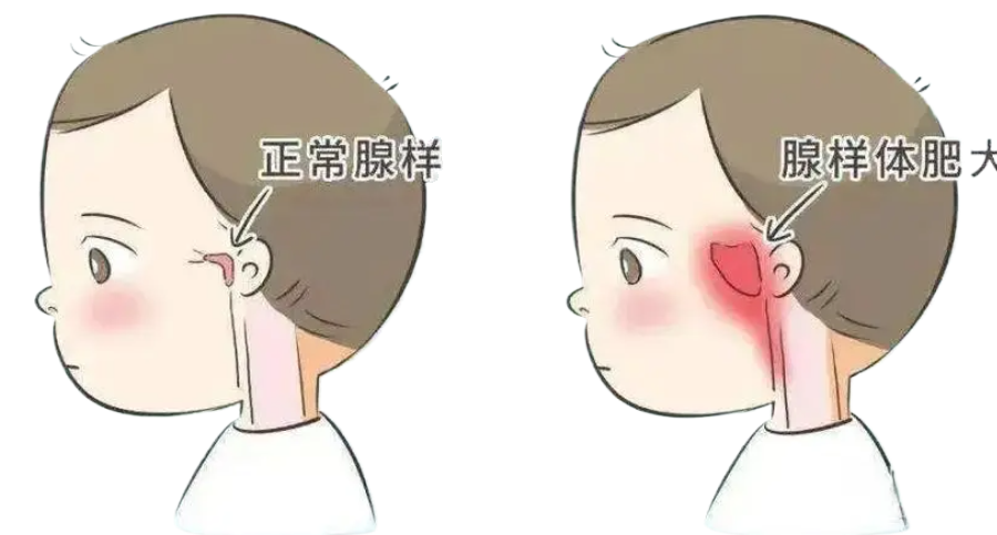 孩子腺樣體肥大影響發(fā)育和容貌，趁五一假期，微創(chuàng)治療快速治愈！(圖1)