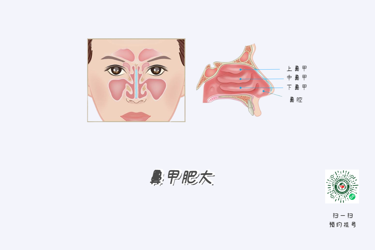 頭痛欲裂？可能是鼻竇炎在作祟！(圖2)